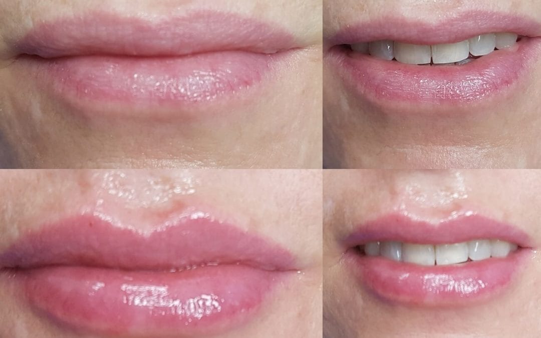 Lip Augmentation 6