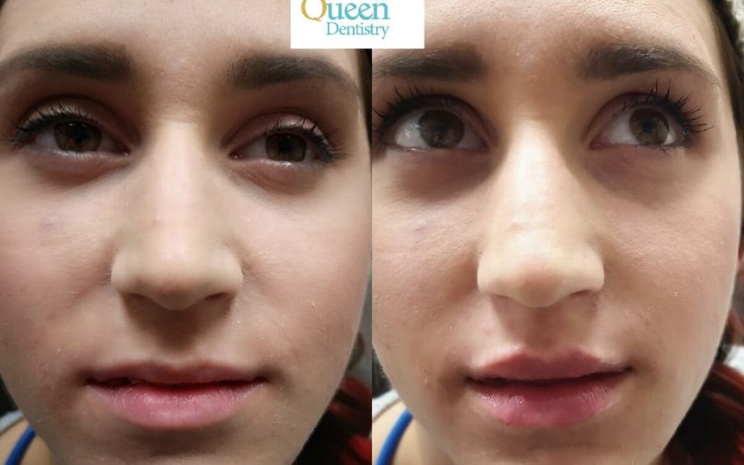 Lip Augmentation 7