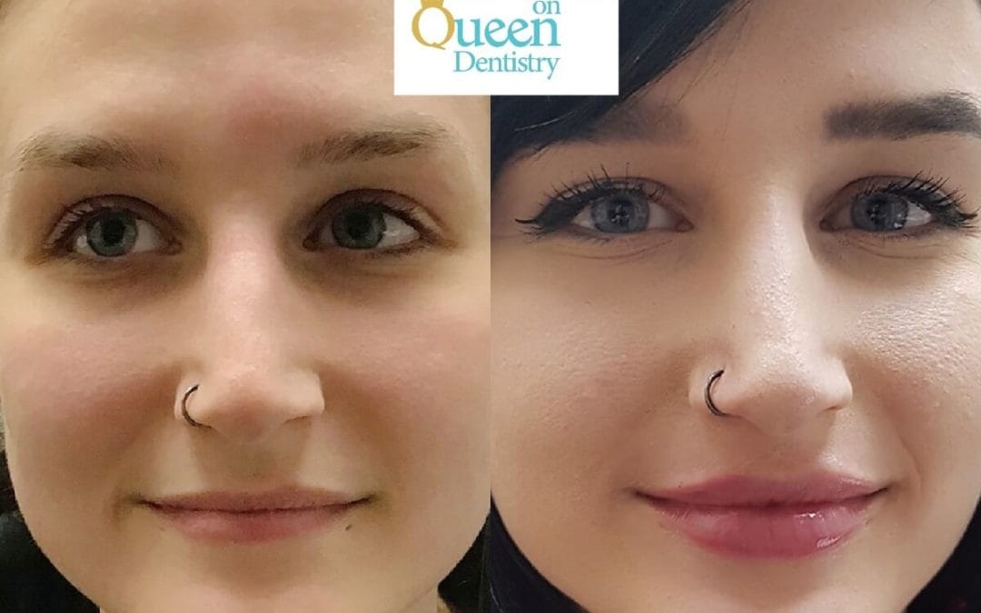 Lip Augmentation 8