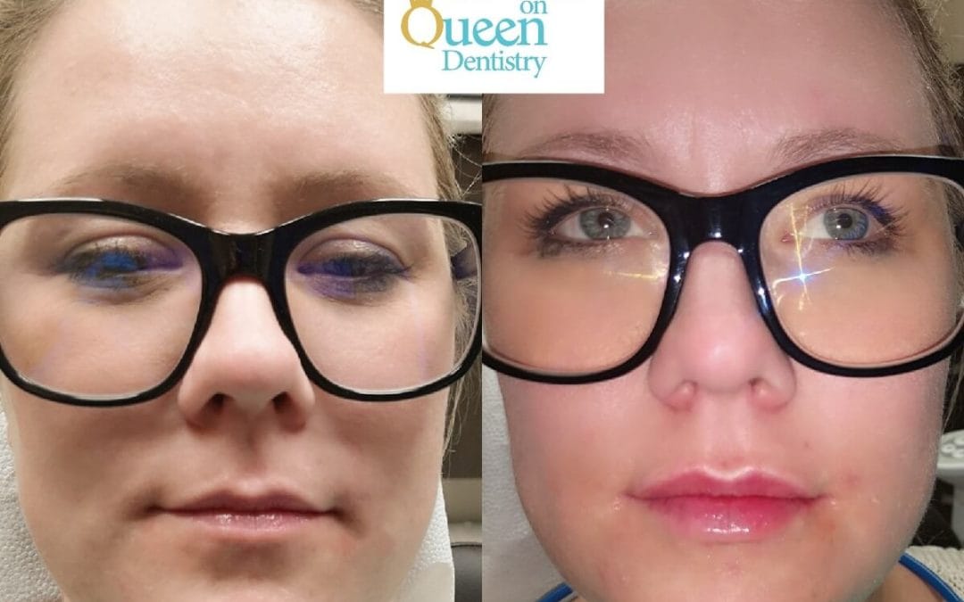 Lip Augmentation 9