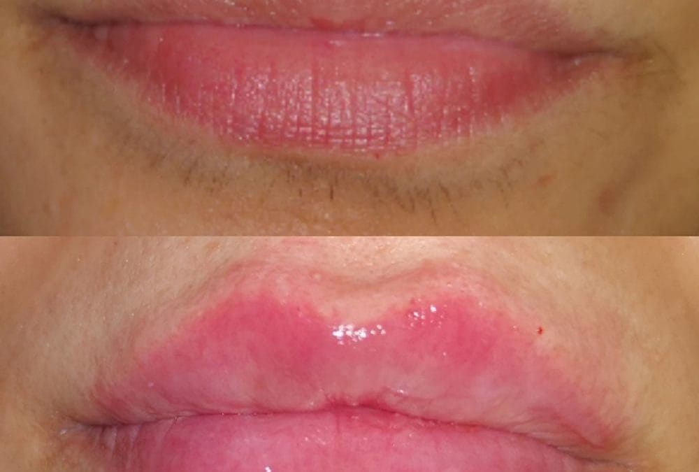 Lip Augmentation 10