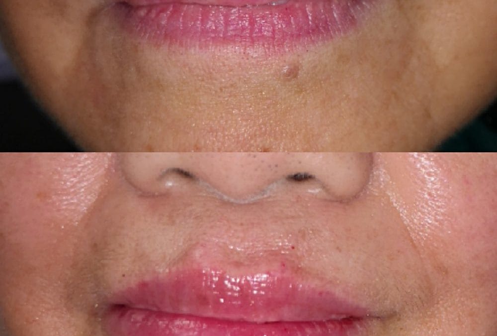 Lip Augmentation 12