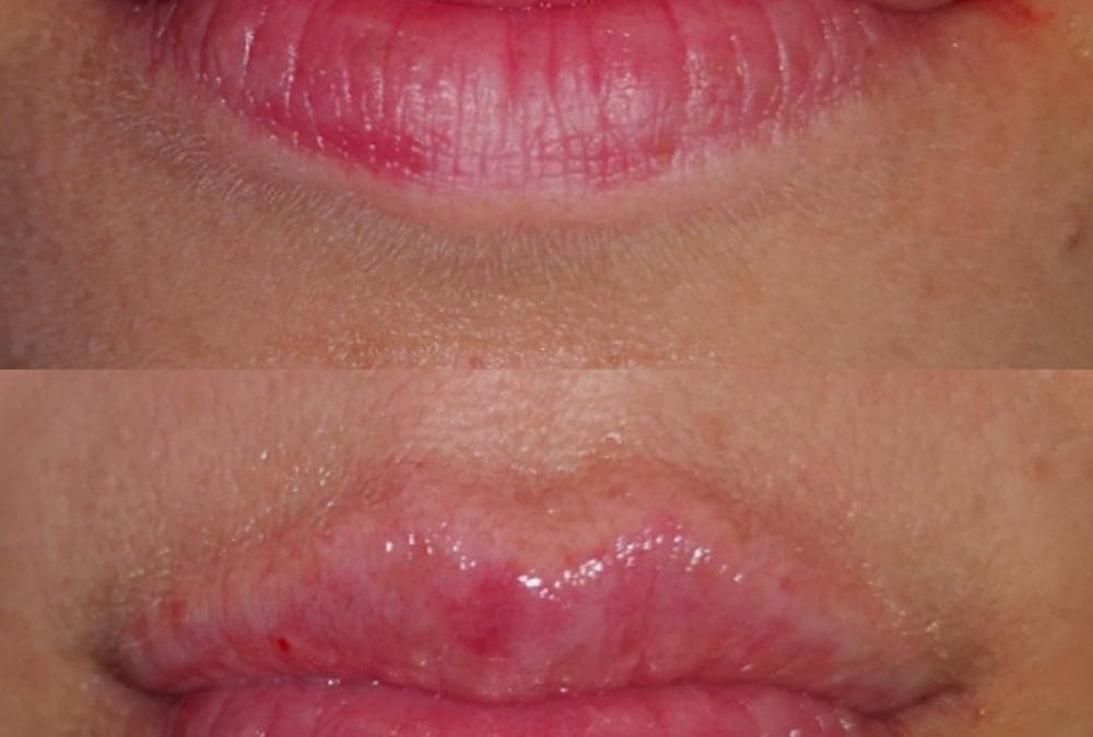 Lip Augmentation 11