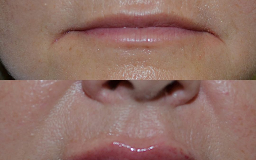 Lip Augmentation 16