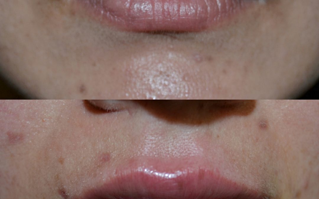 Lip Augmentation 12