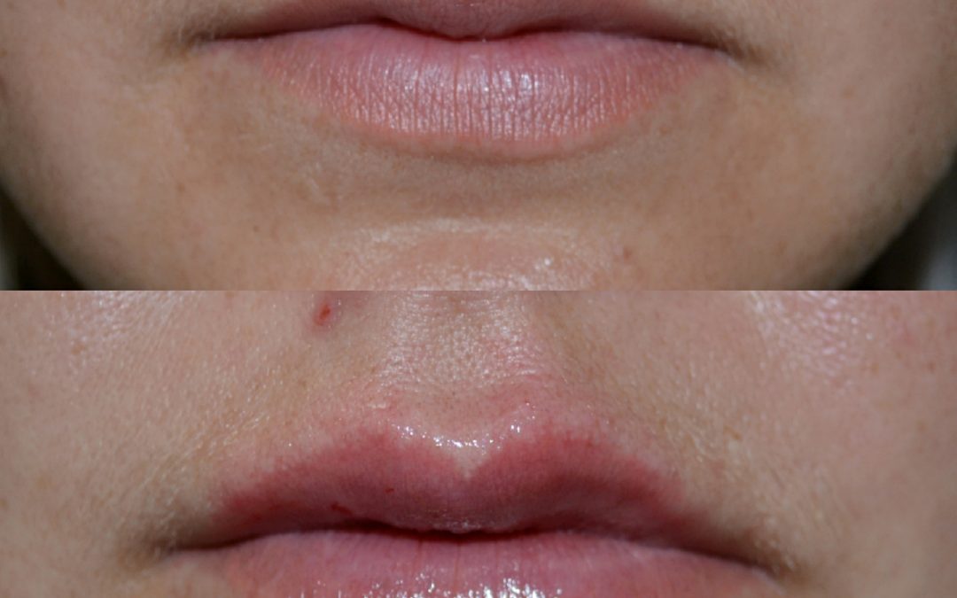 Lip Augmentation 13