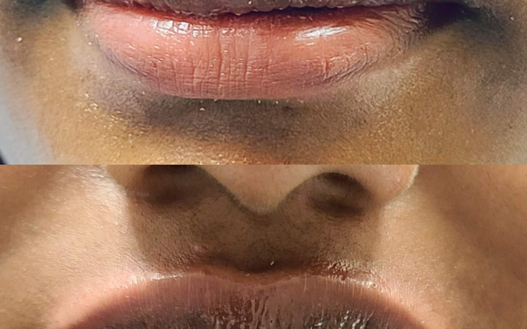 Lip Augmentation 17