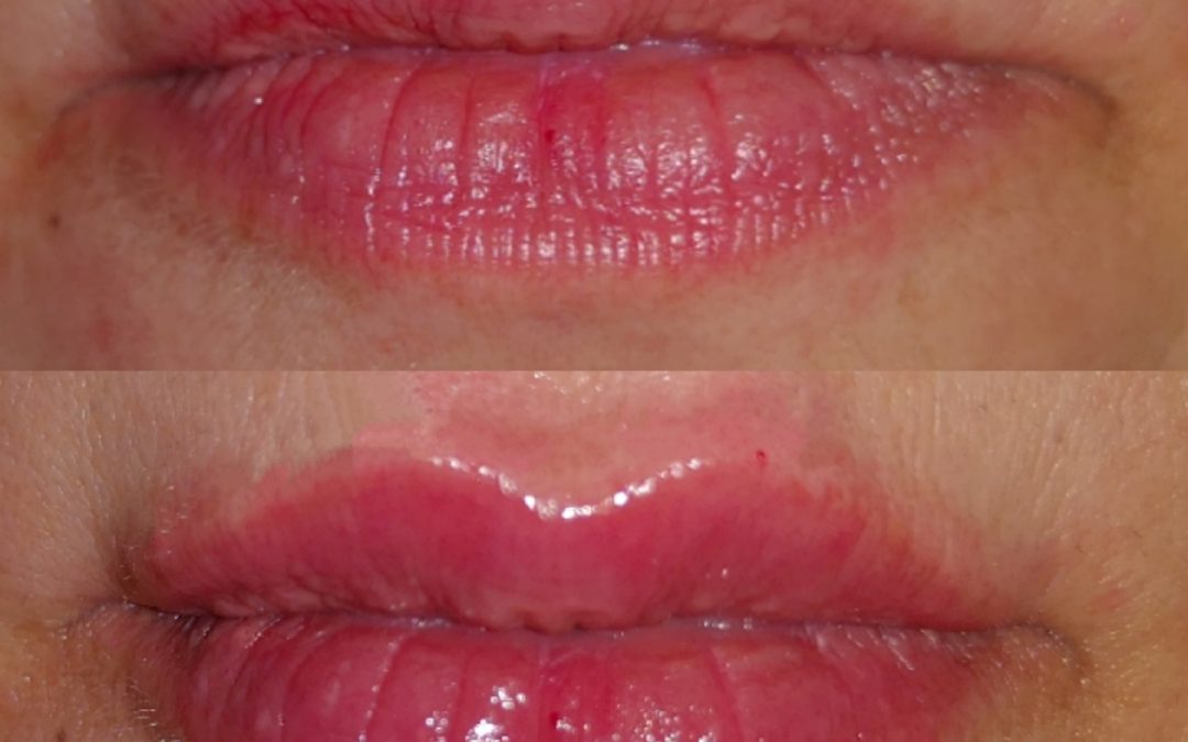 Lip Augmentation