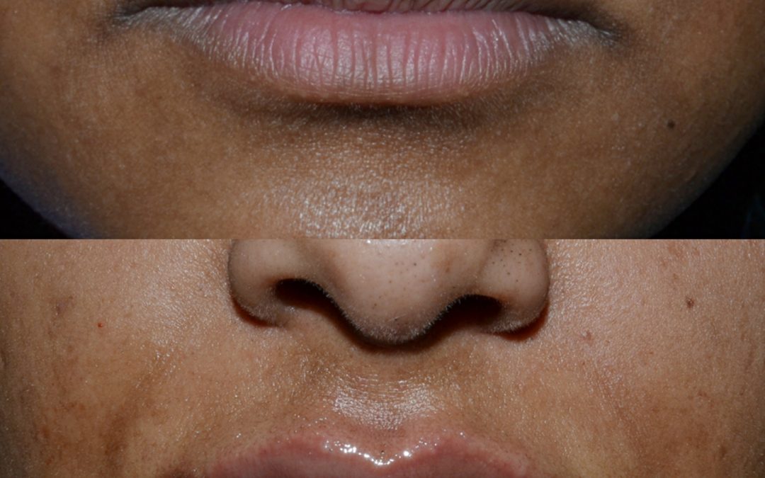 Lips Augmentation – Dec2020