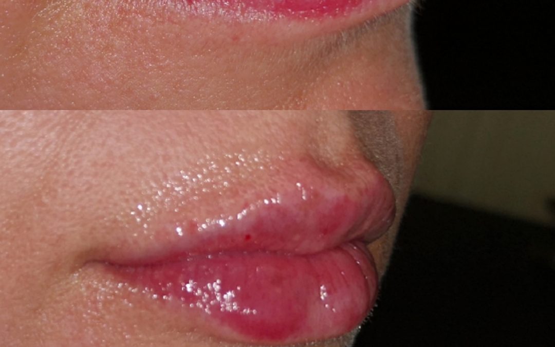 Lip Augmentation
