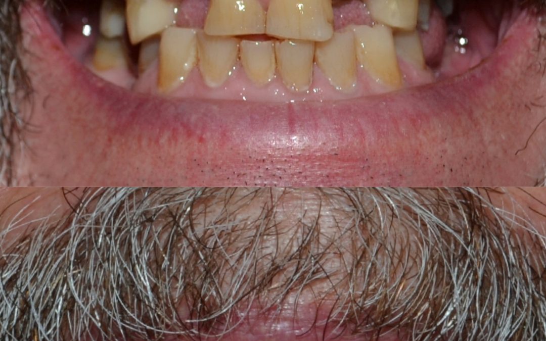 Dental implants 3