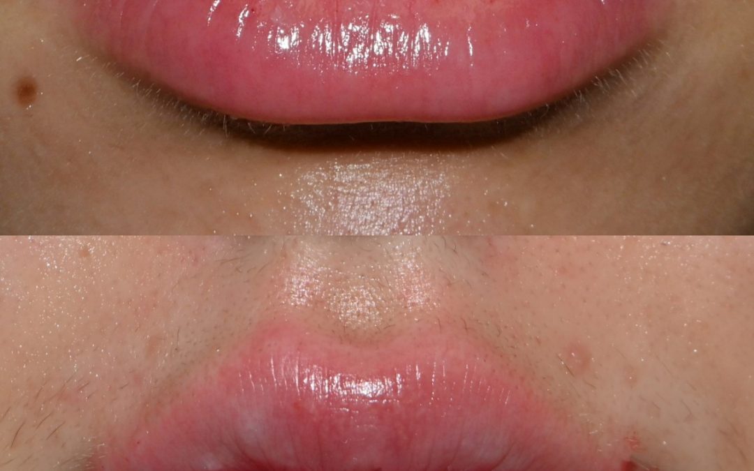 Lip Filler 01